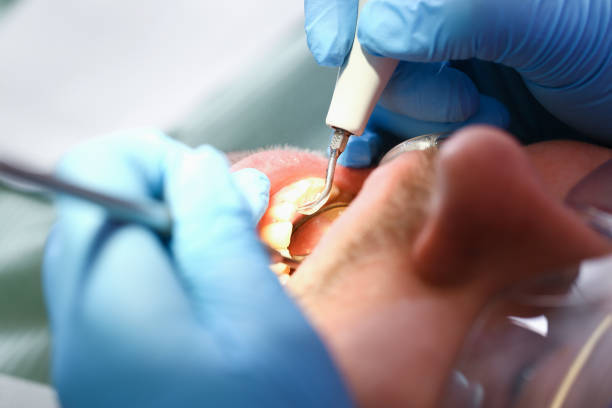 Best Chipped Tooth Repair Near Me  in Malaga, NJ